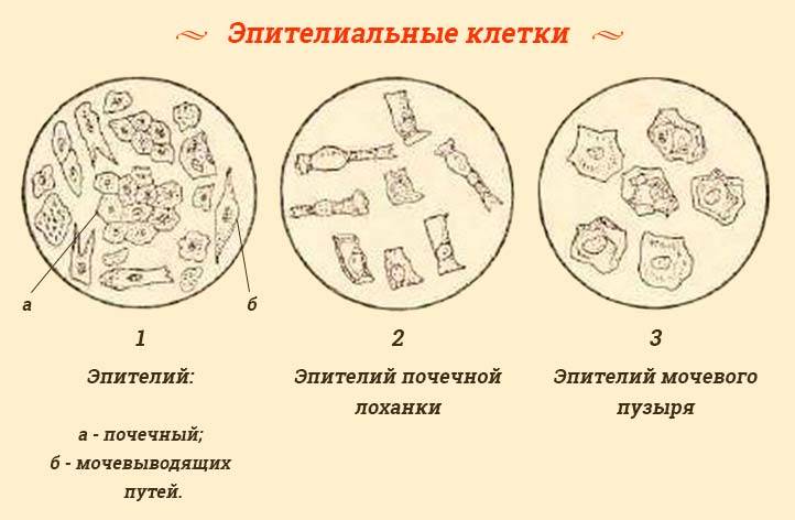 Повышенный эпителий в моче у мужчин