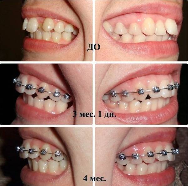 Удаление зуба во время беременности