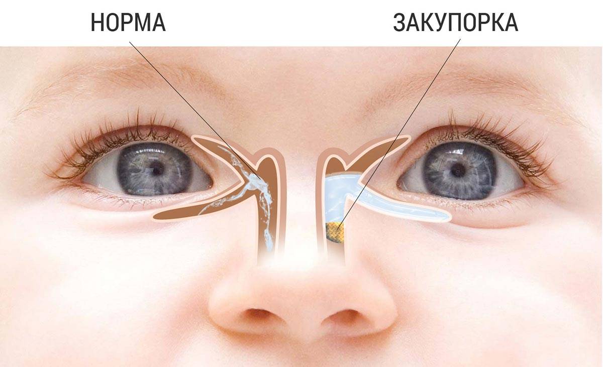 Гноится глаз у новорожденного - чем лечить дома: что делать если загноился глазик у грудного ребенка, комаровский, причины и чем лечить