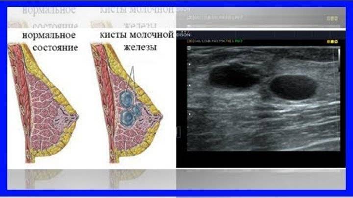 Обследование молочной железы у маммолога: частота посещения, день цикла для осмотра