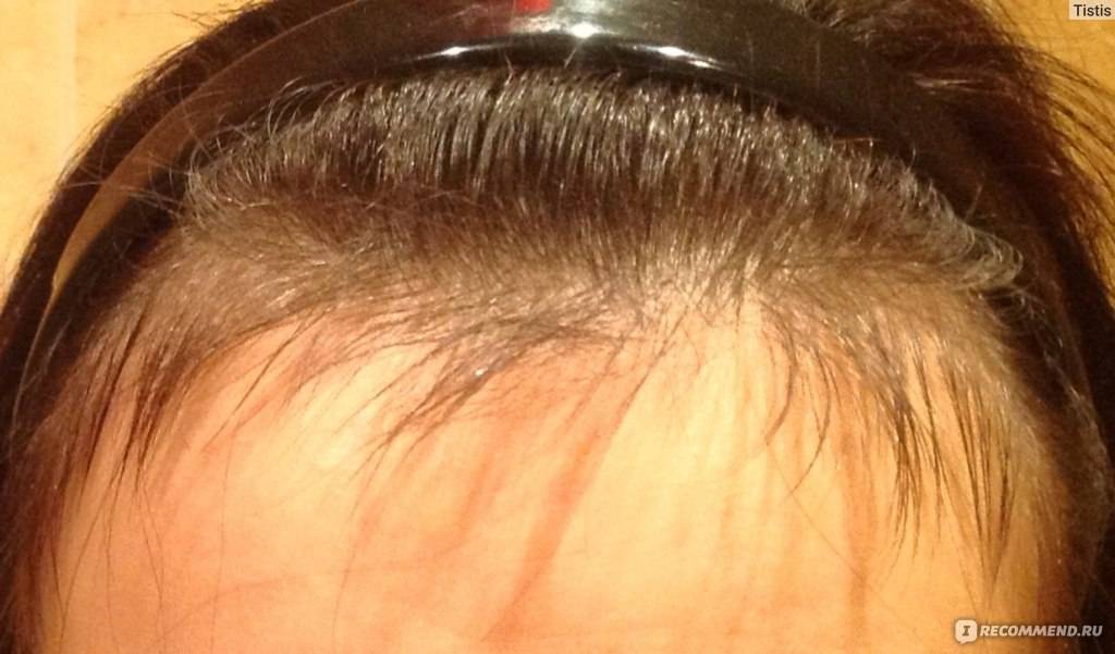 После коронавируса сильно выпадают волосы: что делать с выпадением и как восстановиться: чем лечить, укрепить и остановить и процесс у женщин и мужчин из-за прививки от ковида (короны) – причины и лечение для восстановления