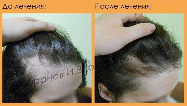 Выпадают волосы при гв | причины выпадения волос при кормлении грудью