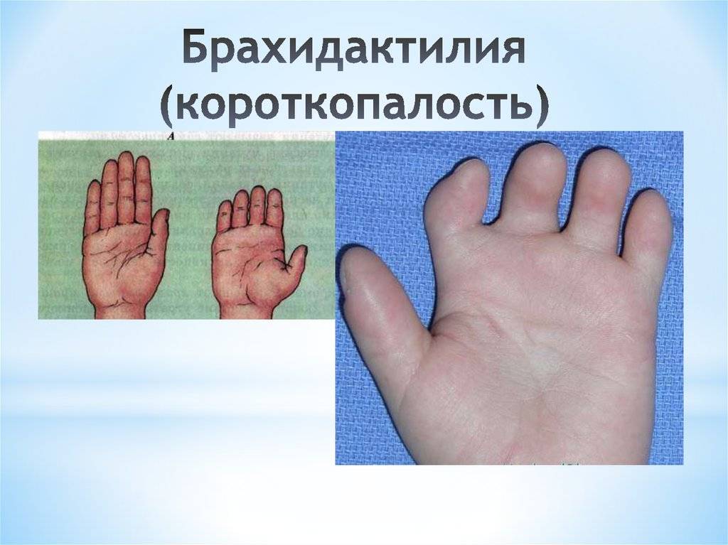 Брахидактилия. короткие пальцы у ребёнка: особенность или серьёзная патология?