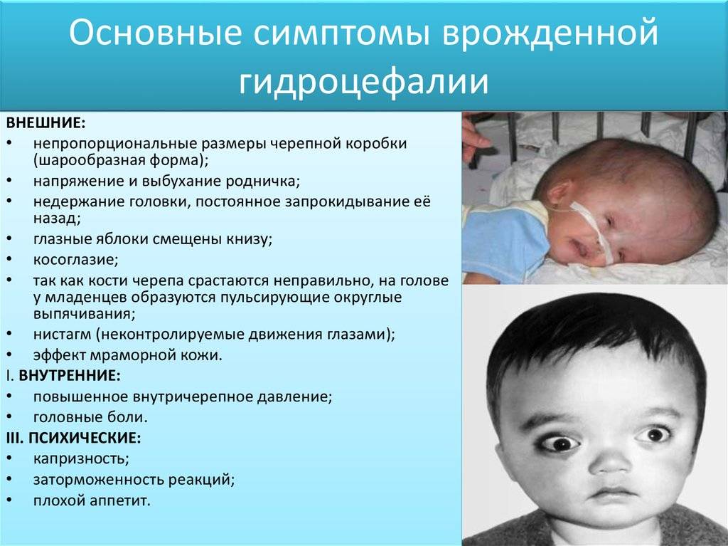 Причины и признаки синдрома Грефе у новорожденных, методы диагностики и лечения
