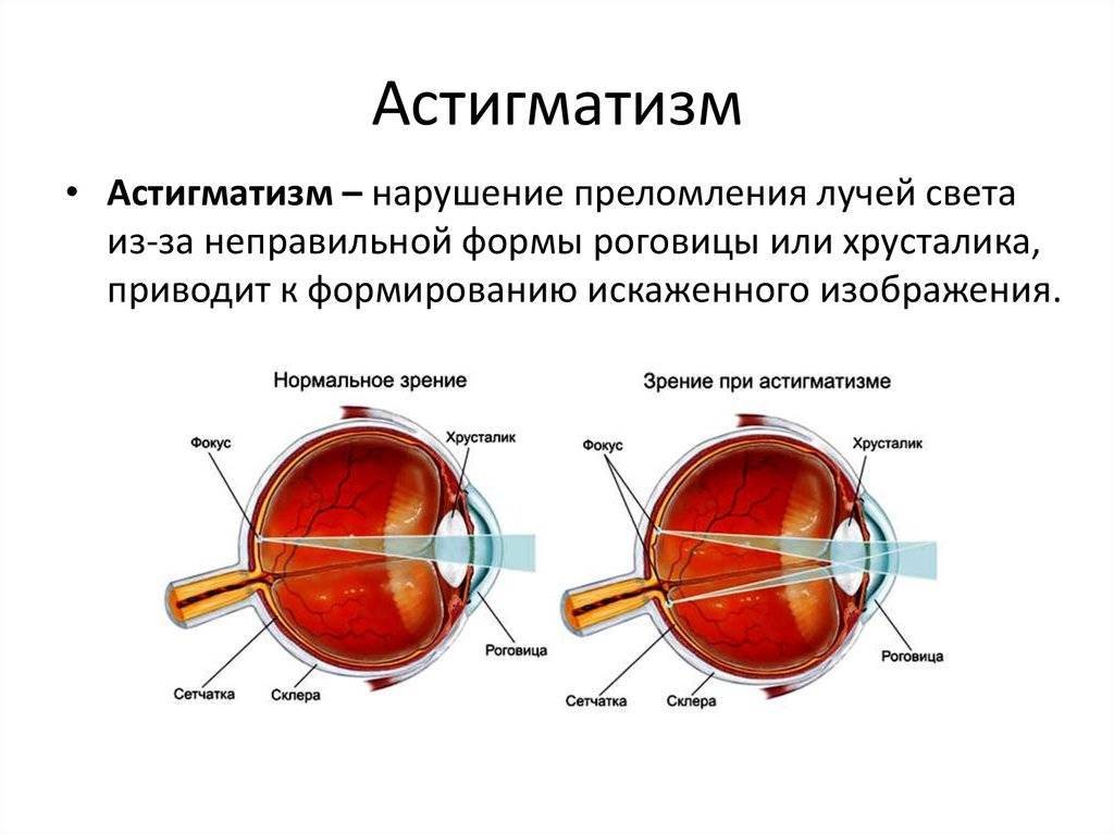 Очки как один из методов коррекции миопии и астигматизма