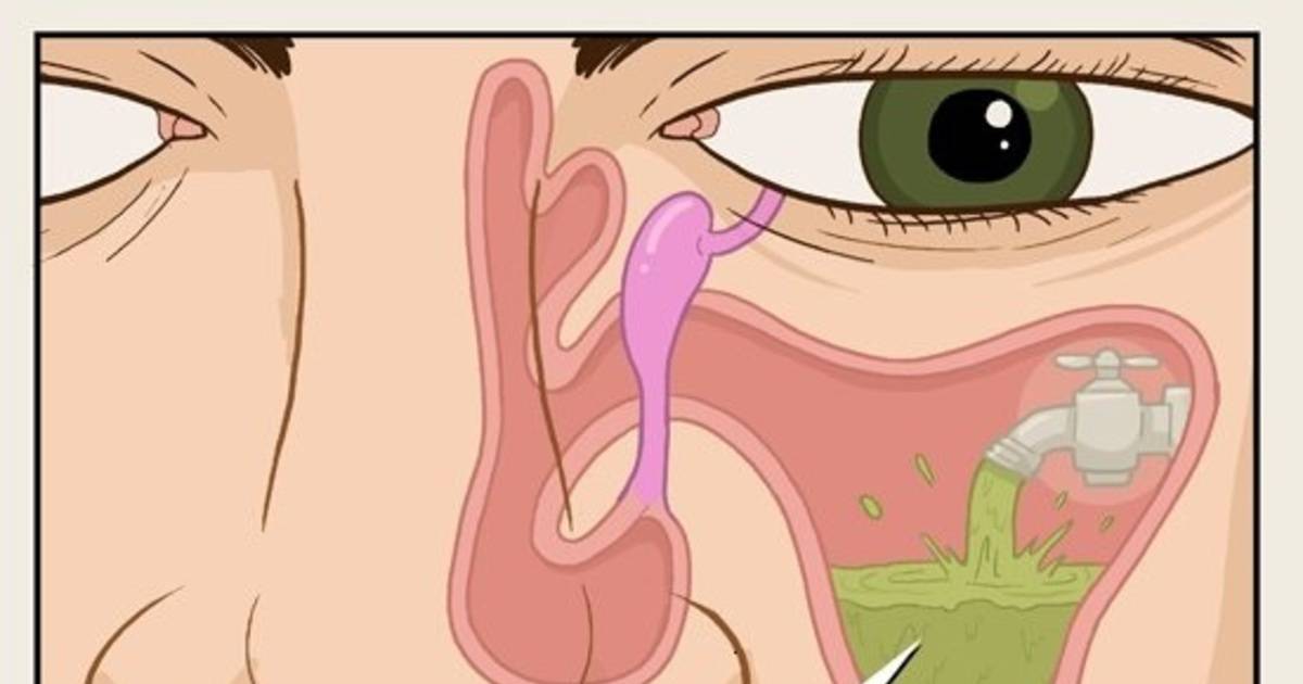 Воспаление носоглотки и пазух носа - причины и лечение
