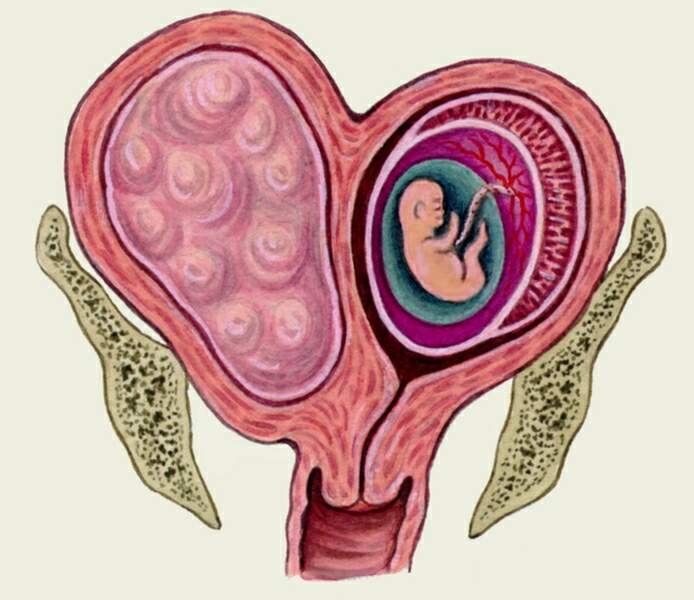 Миома после беременности и родов: происходит ли сокращение и рассасывание узла, лечение и показания к удалению миомы после беременности