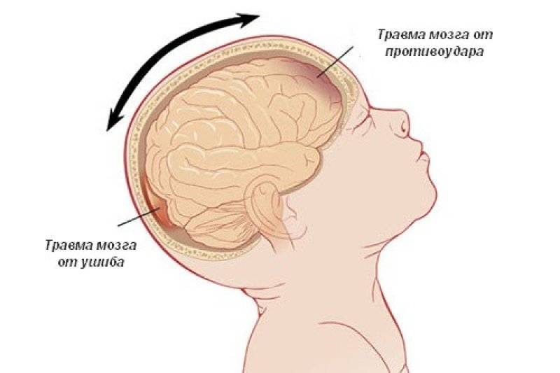 Ушиб головного мозга