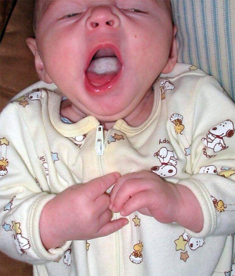 Кандидоз полости рта у детей: основные причины, особенности течения, последствия и терапия