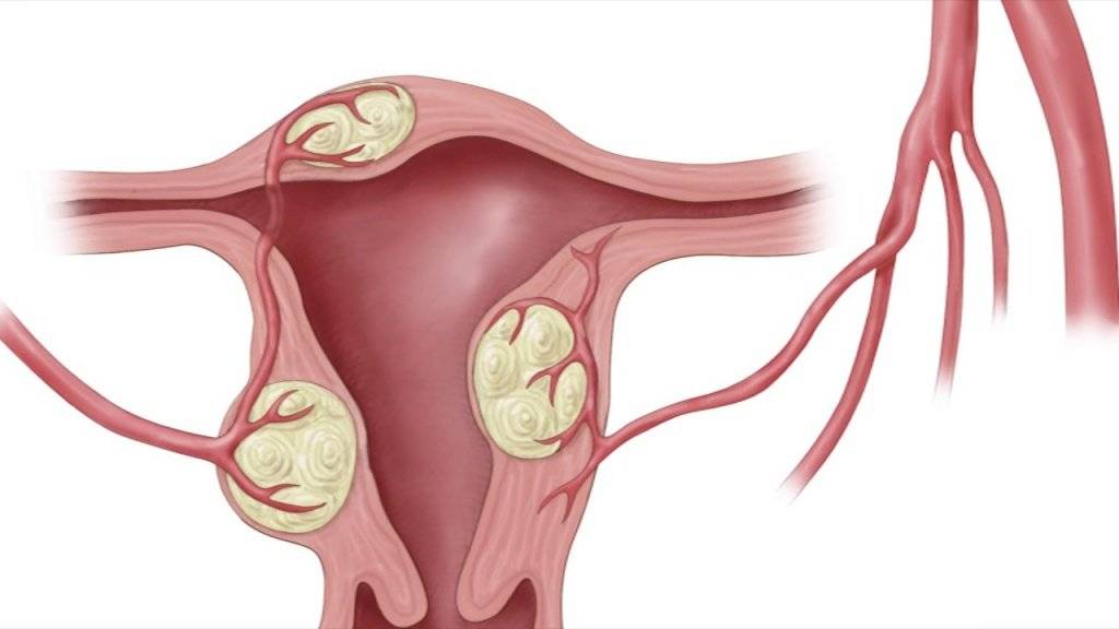 Народные миомы. Интерстициальная миома. Интрамуральная миома матки d25. Интрамуральная миома матки что это такое.