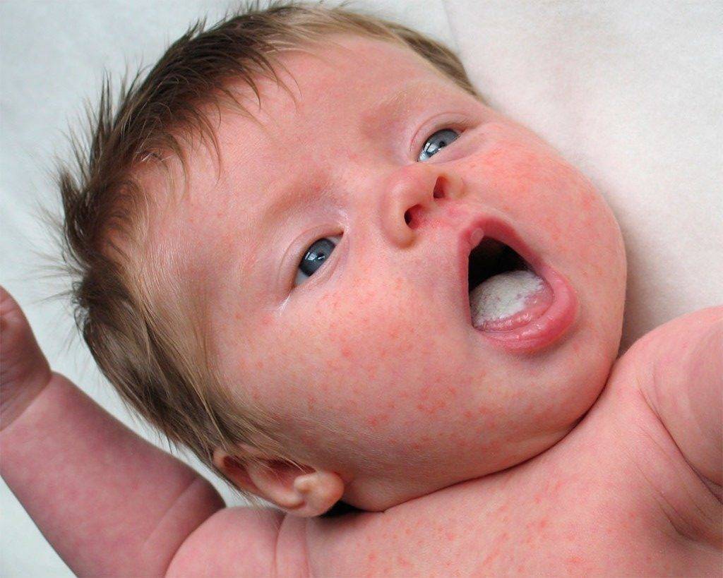 Молочница у детей во рту. как выглядит и чем лечить. | nutrilak