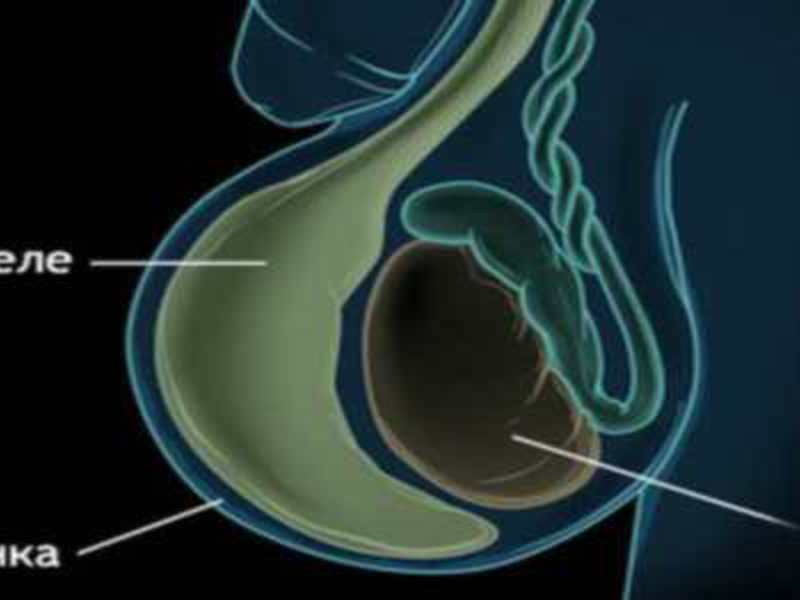 Лечение перекрута гидатиды яичка у ребенка и взрослого