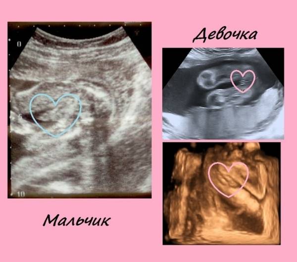 Как определить пол ребенка по сердцебиению: методика и достоверность * клиника диана в санкт-петербурге