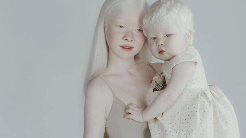 Альбинизм - причины и симптомы, диагностика и лечение альбинизма