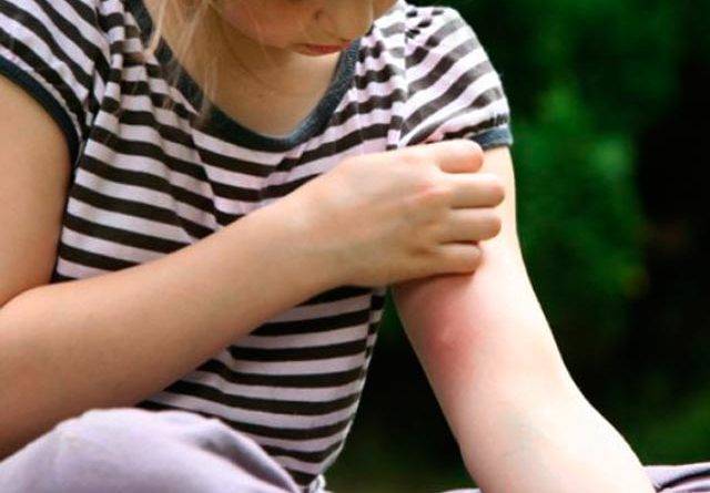 Сильная реакция на укусы насекомых у детей: с чем это связано и как помочь?