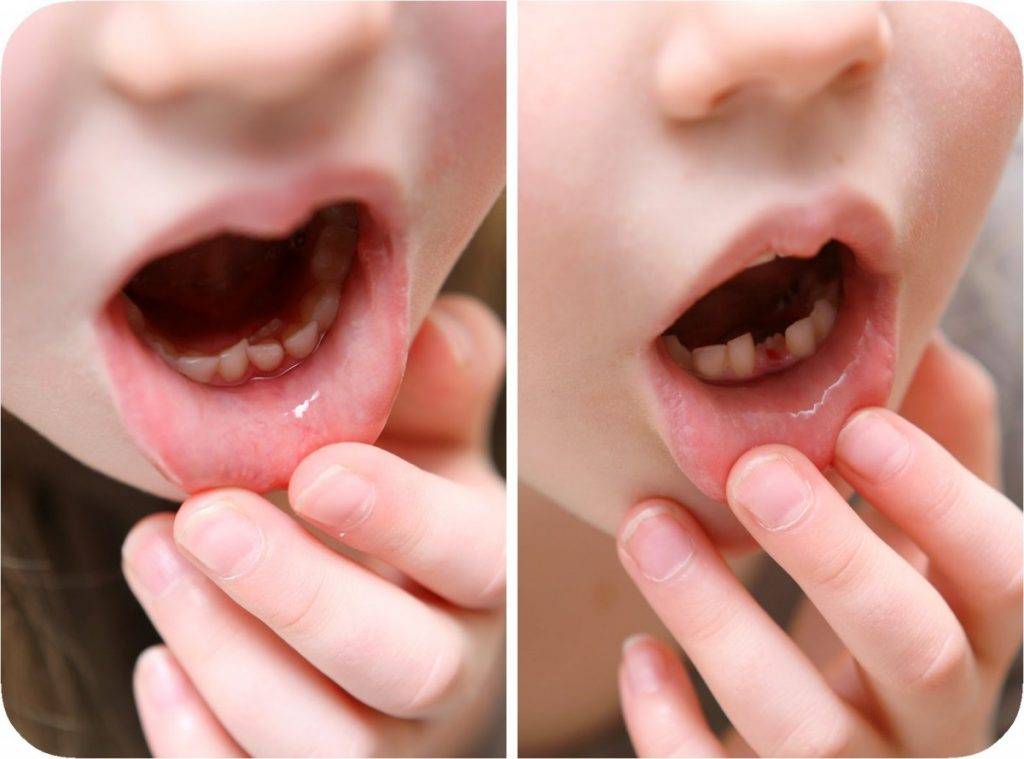 Статья о стоматологии: лечение подвижных зубов у детей