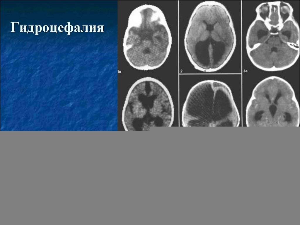 Гидроцефалия головного мозга у детей: 4 ведущих метода диагностики и 2 подхода к лечению