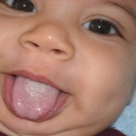 Белый налет на языке у ребенка: норма, причины и симптомы болезней