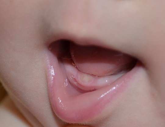 Этапы прорезывания зубов у новорожденных детей | babydent