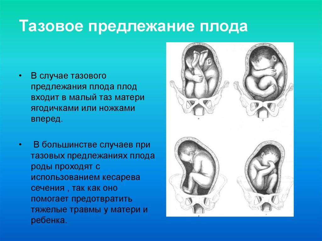 Когда ребенок переворачивается в животе вниз головой и принимает правильное положение (позу) перед родами | house-fitness.ru
