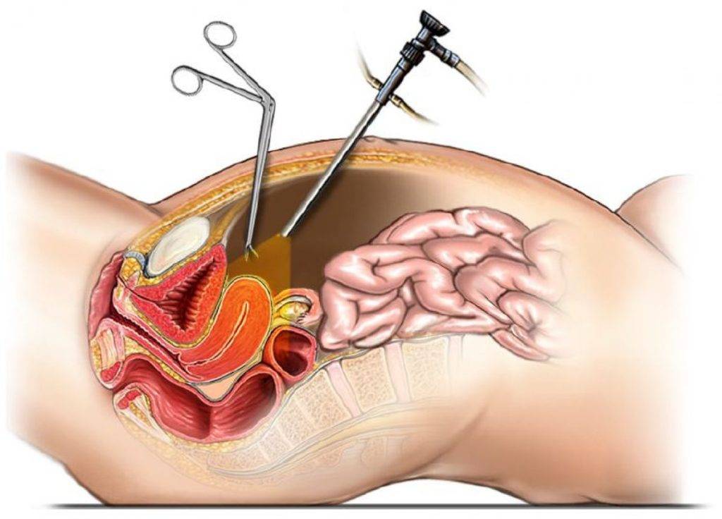 Ранние и поздние осложнения гинекологической хирургии: оценка в визуальных тестах