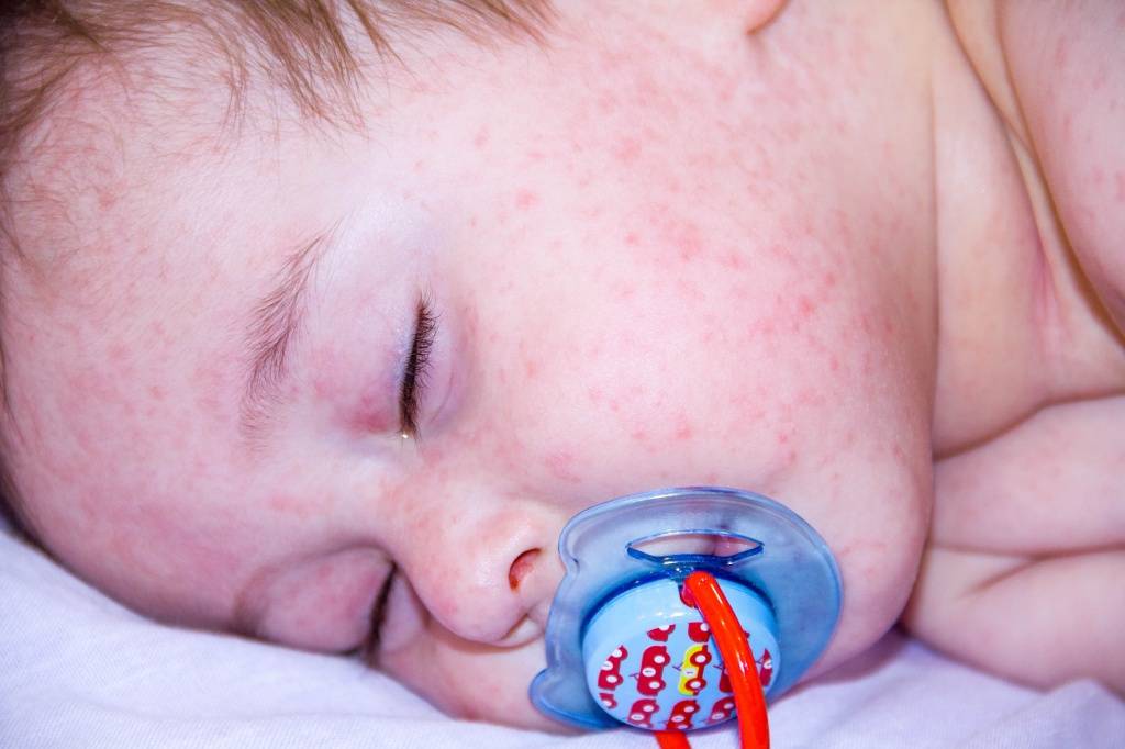 Аллергия у новорожденного