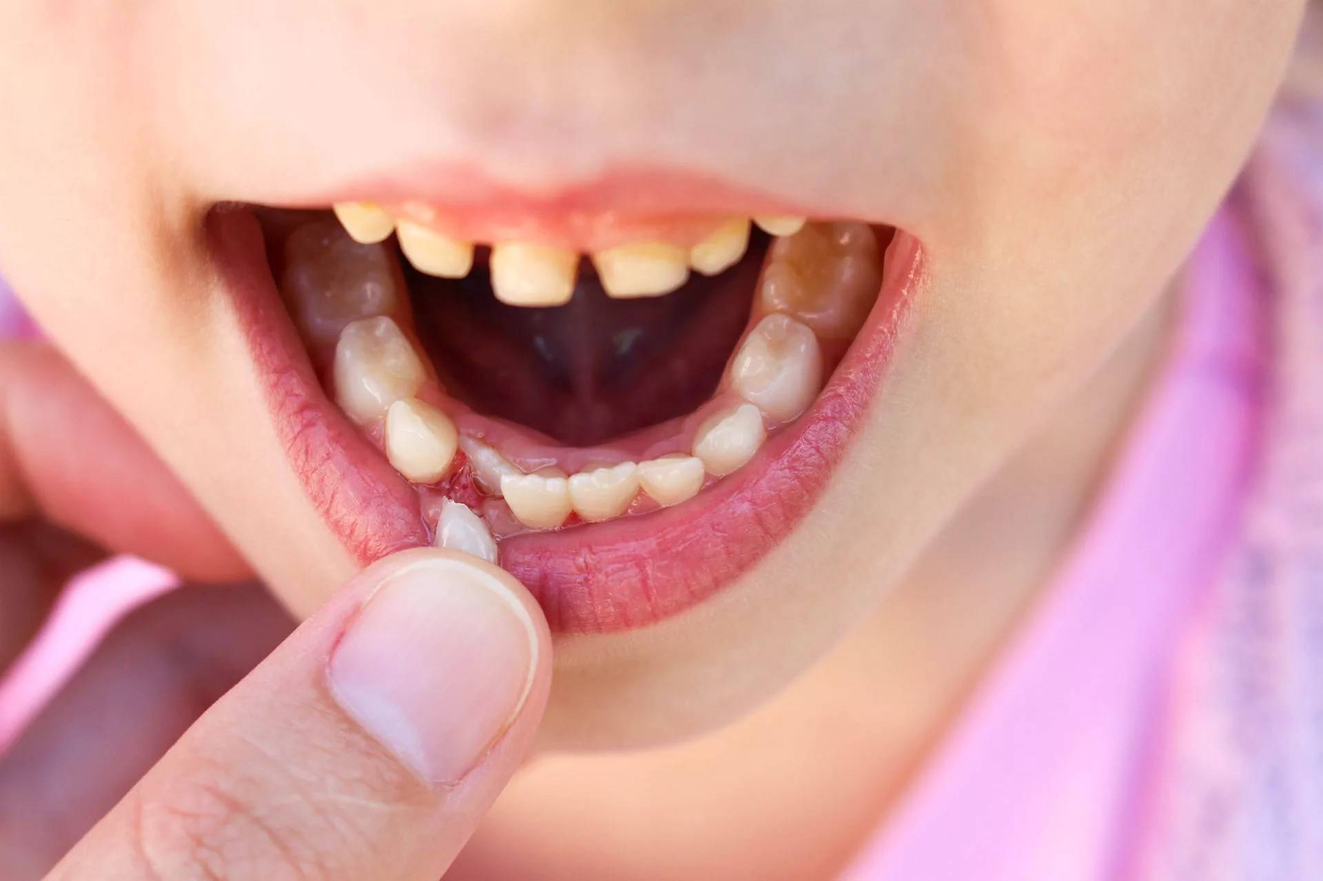 Трещина на эмали переднего зуба: что делать с вертикальной зубной микротрещиной, как убрать, если треснул резец, чем его лечить – причины, лечение и симптомы
