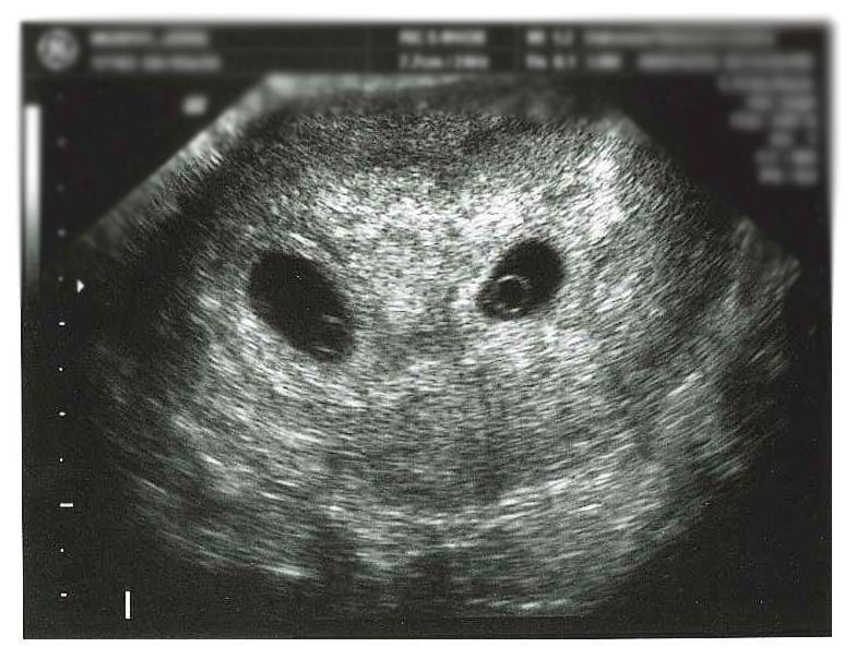 Узи на 4 неделе беременности фото двойня