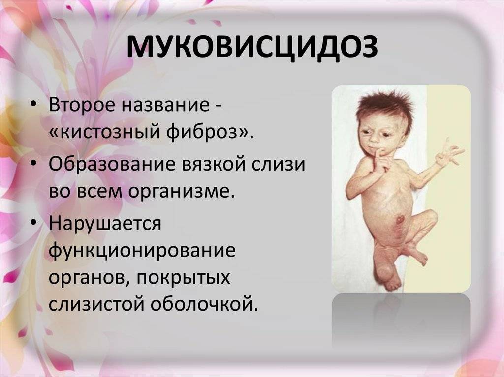 Симптомы и лечение муковисцидоза у новорожденных: как проявляется заболевание