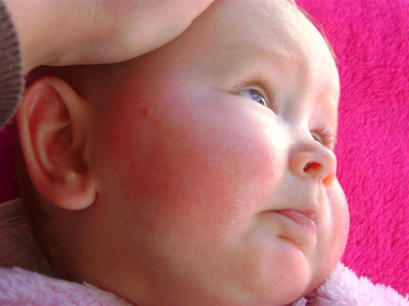 Аллергия на лице у ребенка: причины и лечение