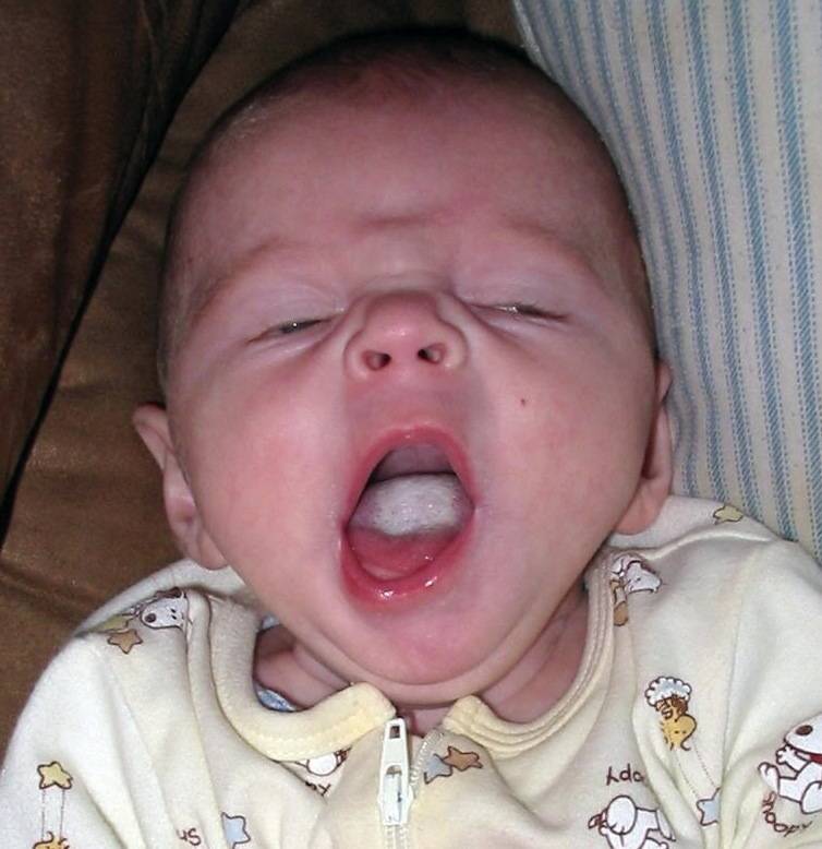 Кандидоз полости рта у детей: основные причины, особенности течения, последствия и терапия