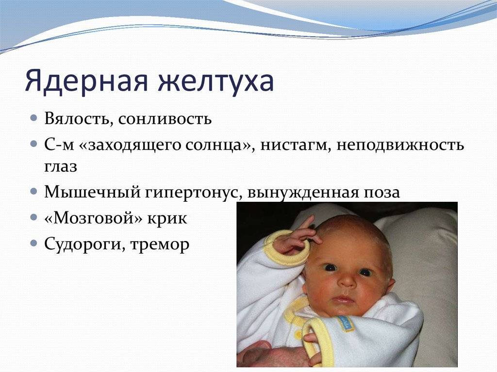 Желтушка | детский медицинский центр "чудодети"