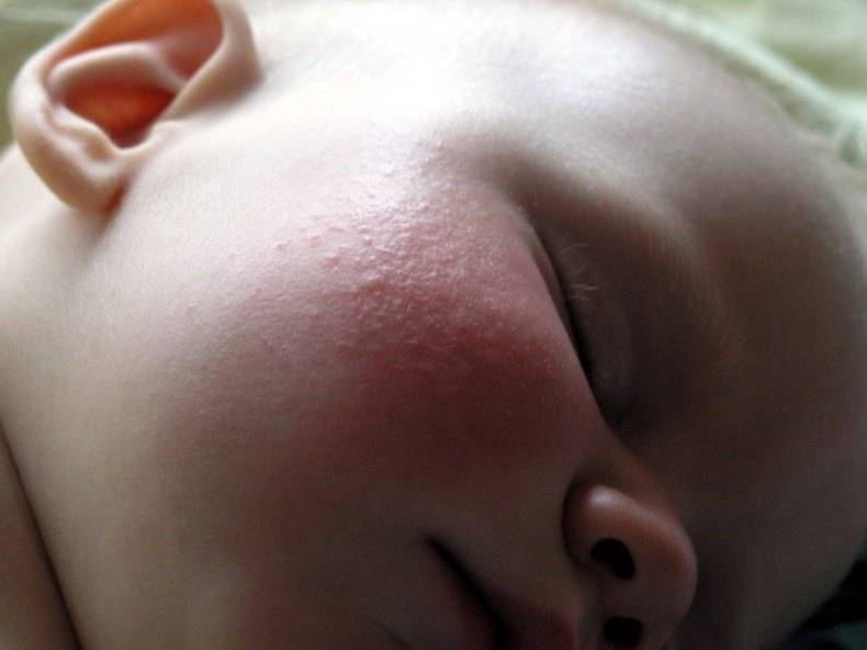 Пузырчатка (пемфигус) у детей: симптомы, которые требуют обращения к дерматологу