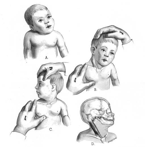Эпилепсия у новорожденных