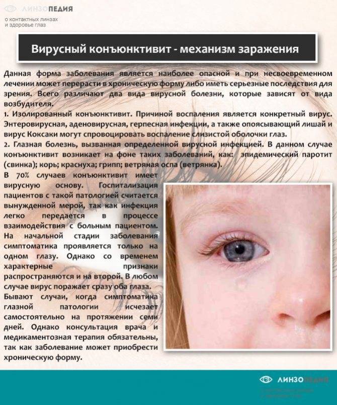 Лечение конъюнктивита у младенцев - энциклопедия ochkov.net