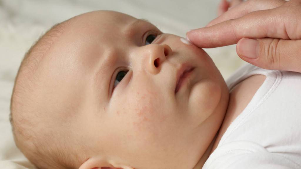 Пузырчатка (пемфигус) у детей: симптомы, которые требуют обращения к дерматологу