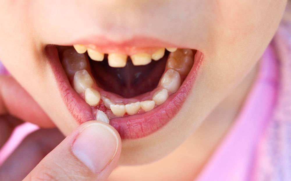 Что делать, если шатается молочный зуб у ребенка