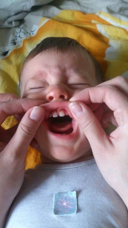 Короткая уздечка языка у новорожденного ребенка