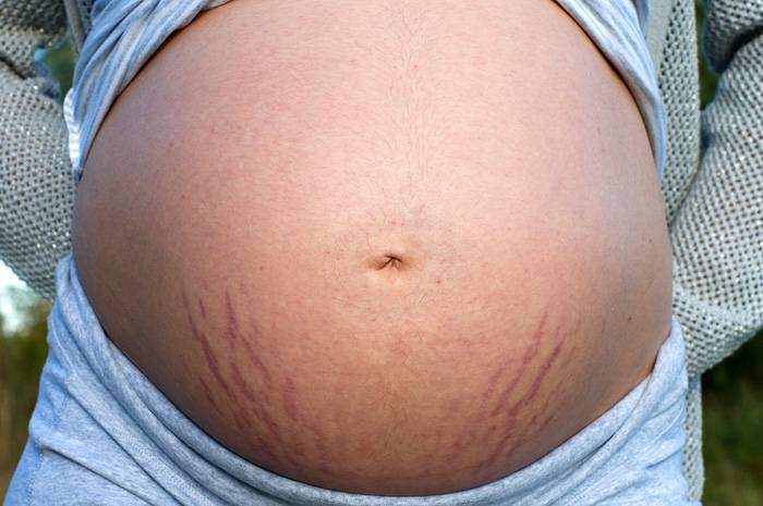 Как избежать растяжек и лишнего веса при беременности