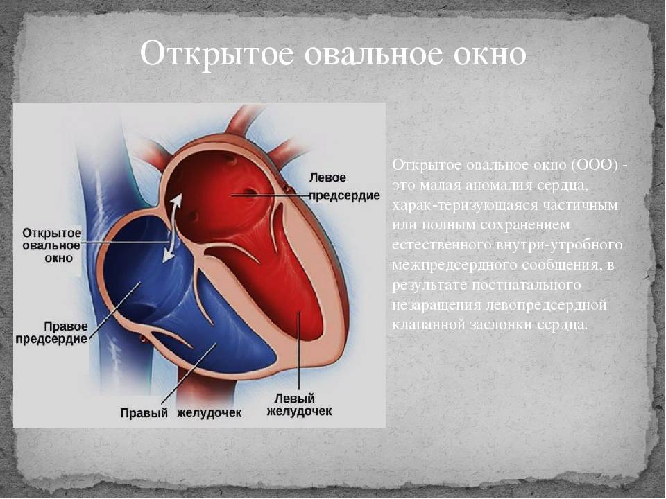 9 вопросов кардиологу об открытом овальном окне сердца