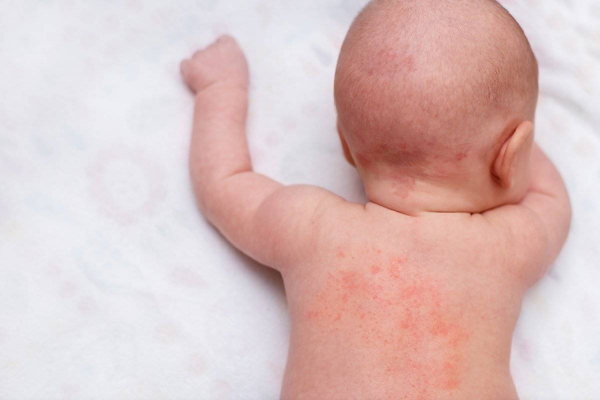 18 болезни кожи новорожденных - студизба
