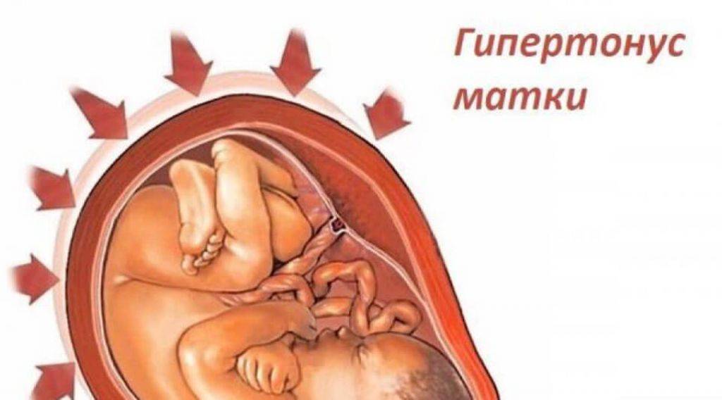 Тонус матки при беременности — беременность. беременность по неделям.