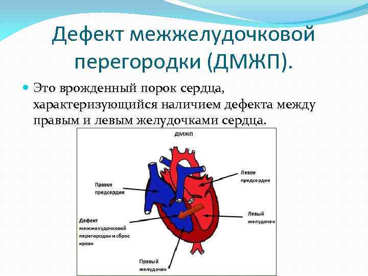 Врожденный порок сердца у новорожденных — классификация, симптомы, лечение