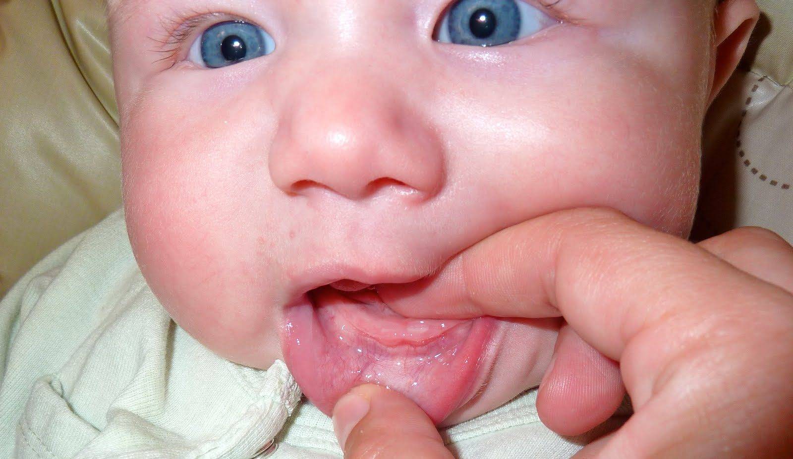 Причины белого налета на языке у ребенка