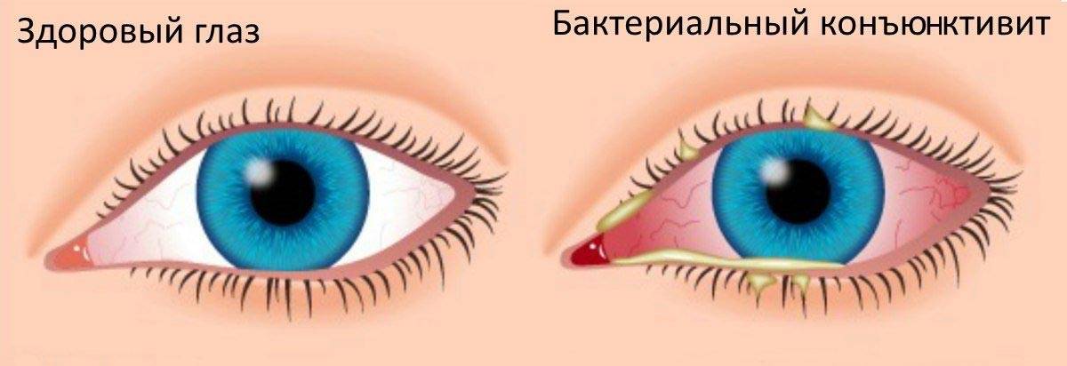 Вирусный Конъюнктивит У Детей Фото
