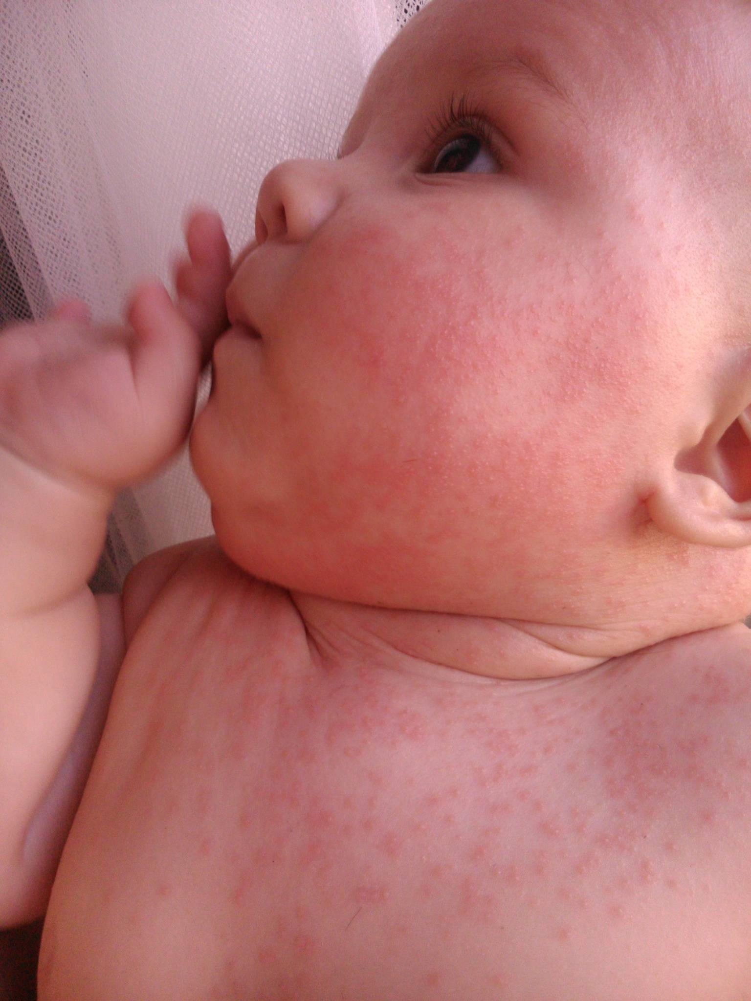 Врожденный пигментный невус у детей, удаление невуса ребенку кожи на голове, шеи или туловище, лечение сосудистого невуса у новорожденных