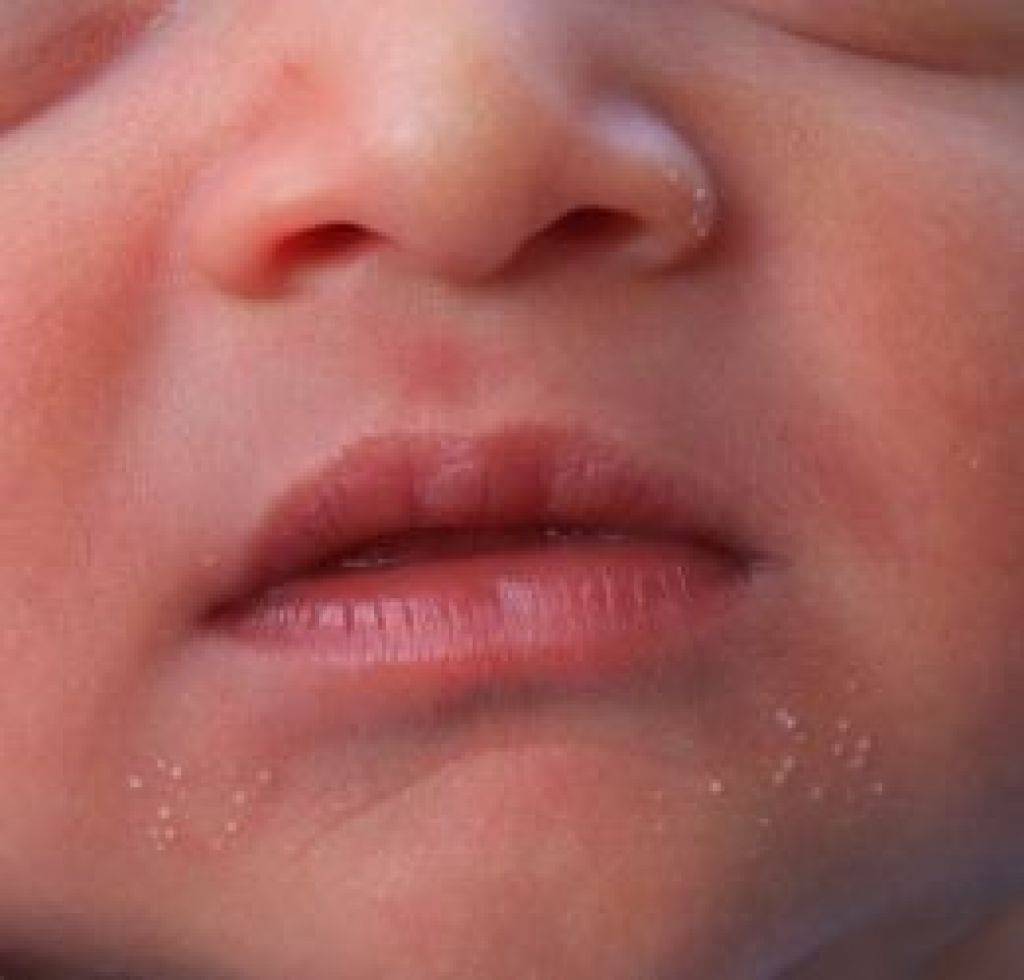 Жировики у новорожденных — причины появления и лечение
