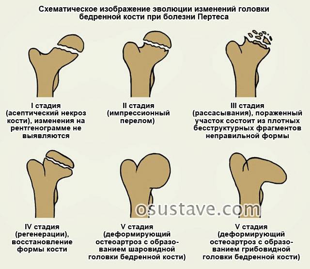 Болезнь пертеса у детей - лечение в минске (беларусь) | ortoped.by