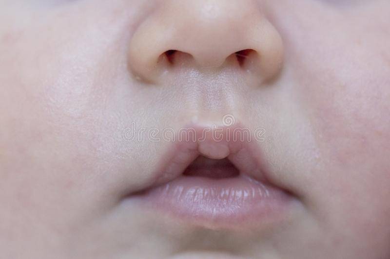 Мозоль на губе у новорожденного и грудничка: причины появления и фото с пояснениями