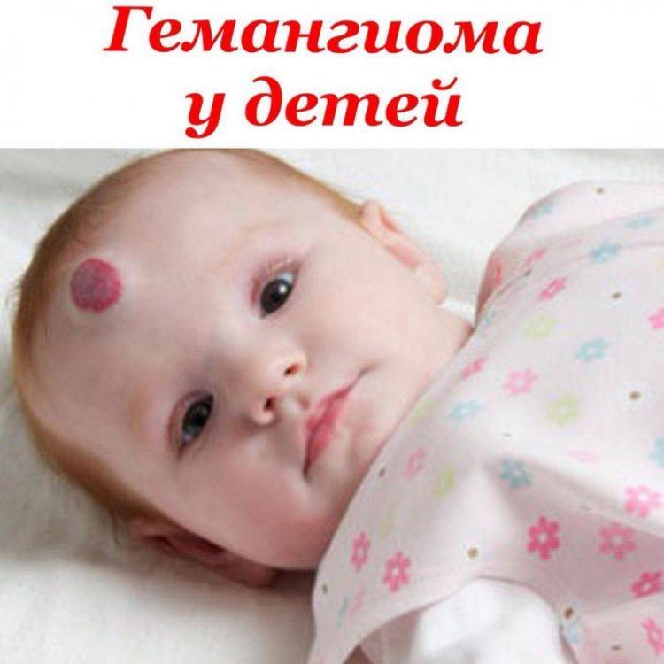 Гемангиома младенческая - причины, симптомы, диагностика, лечение и профилактика